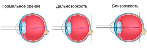 Отличить дальнозоркость и близорукость: на что обратить внимание