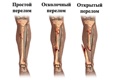 Очные признаки перелома нижней конечности и повышения температуры
