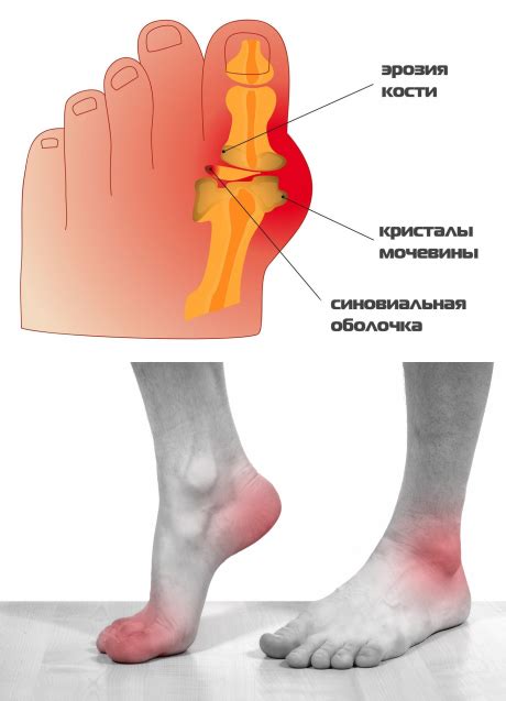 Подагра: появление и характеристика заболевания