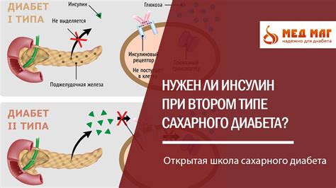 Подготовка к занятиям бегом при втором типе диабета: важные аспекты