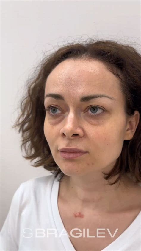 Подготовка к хирургическому вмешательству для изменения формы лба