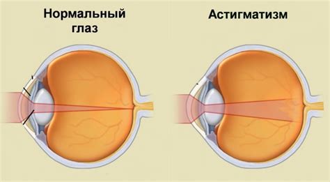 Показания для вмешательства, направленного на восстановление оптической функции глаза