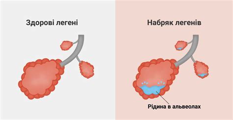 Положительное влияние восполнения жидкости на выведение отека из легких