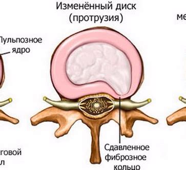 Полуторная жесткость: промежуточный вариант для отдыха при протрузии межпозвоночного диска