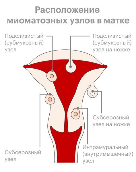 Понимание механизмов развития миомы