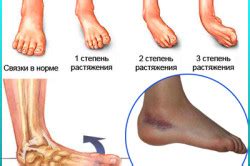 Понятие повреждения стопы и его последствия