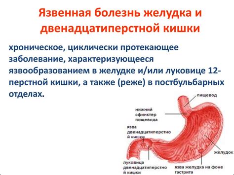 Понятие язвы двенадцатиперстной и ее проявления