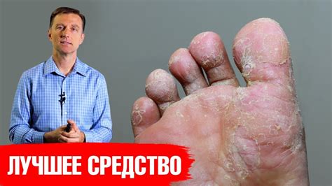 Поражение стопы псориазом: симптомы и способы облегчения