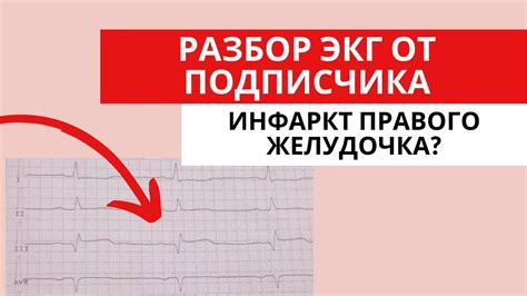 Потенциальные воздействия на организм при отклонении правого желудочка вперед на ЭКГ