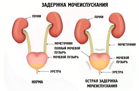 Почему возникают трудности при мочеиспускании у мужчин