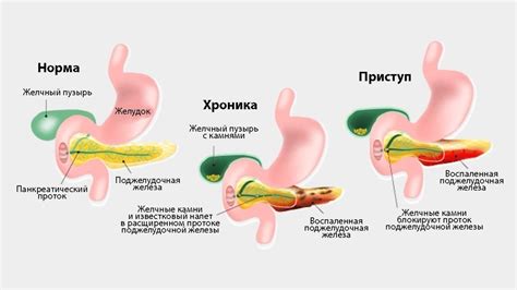 Почему у женщин возникают проблемы с функцией поджелудочной железы