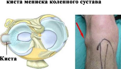 Предупреждение повреждений мениска: рекомендации экспертов