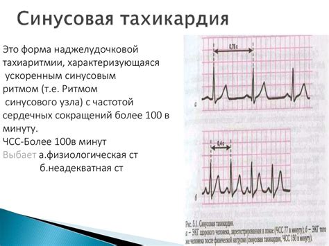 Преимущества поддержания физической активности при диагнозе синусовой тахикардии