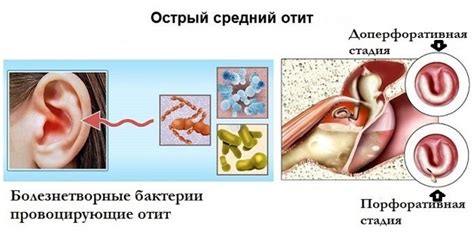 Признаки воспаления среднего уха у детей и взрослых