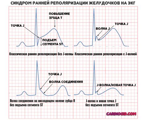 Признаки неспецифической реполяризации