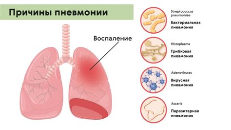 Причины вирусной пневмонии КТ2