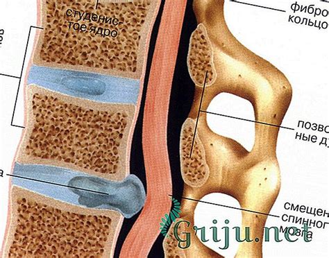 Причины возникновения грыж позвоночника