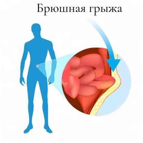 Причины возникновения новообразований в брюшной полости