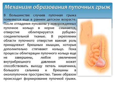 Причины возникновения пупочной грыжи и факторы риска