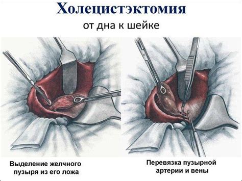 Причины и последствия раздвигания шва после хирургического вмешательства