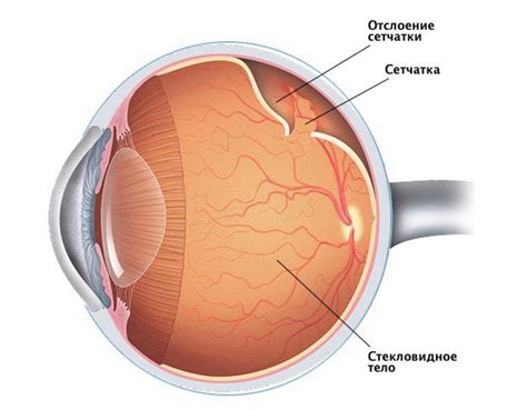 Причины и симптомы отслойки ретины: основные факторы и проявления