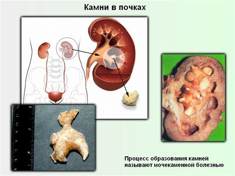 Причины образования новообразований в почках