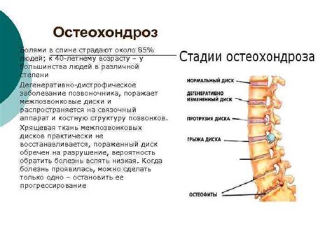 Проблема остеохондроза и необходимость лечения