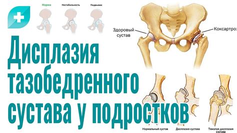 Проблемы, связанные с величиной, структурой и функцией области около тазобедренного сустава у дам