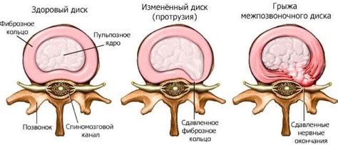 Профилактика и лечение протрузии позвоночного диска при нарушении кровообращения в организме