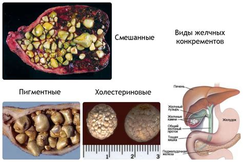 Профилактика образования новообразований в почках