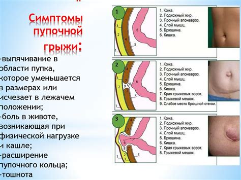 Профилактика пупочной грыжи и рекомендации по укреплению центральной части живота