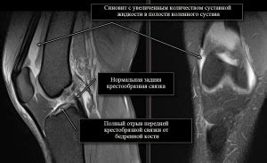 Процесс формирования и развития структур вокруг коленного сустава у малышей