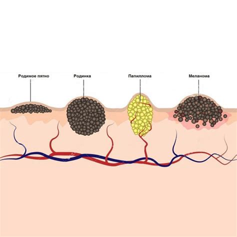 Процесс формирования папилломы: механизмы возникновения и развития