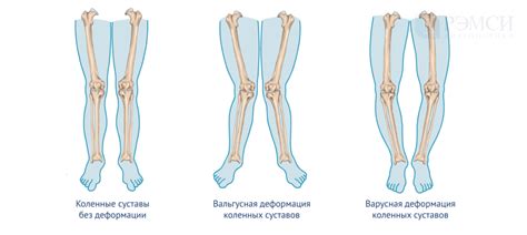 Проявления наличия коленных элементов у младенцев и характерные признаки