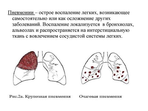 Проявления пневмонии при ковид