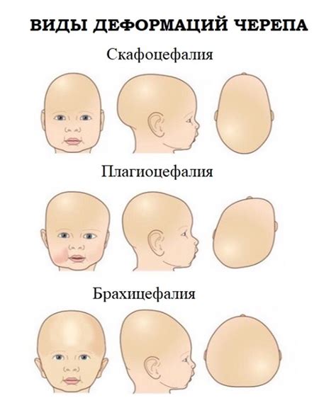 Развитие склепа головы у новорожденных