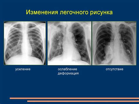 Различение обогащения легочного рисунка от других патологических изменений на снимках