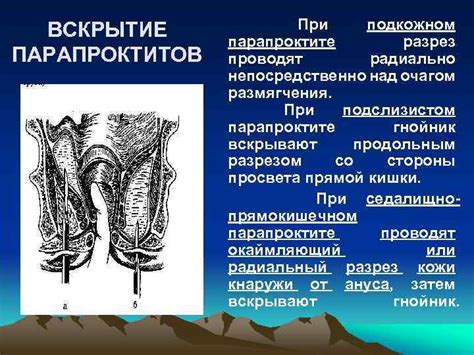 Различные методы оперативного вмешательства при свище в прямой кишке