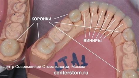 Разница между виниром и коронкой