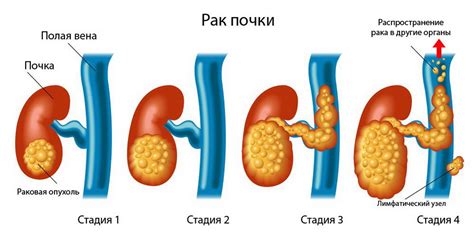 Рак почки