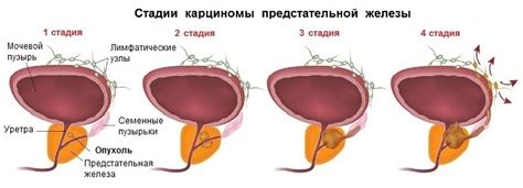 Распространение рака простаты далеко за пределы железы