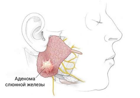 Расстройства околоушной железы: симптомы и признаки