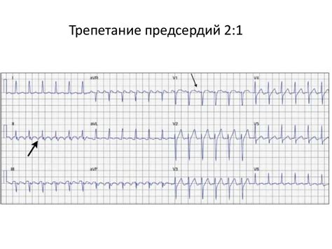 Расшифровка тахикардии: понимание этого сердечного ритма