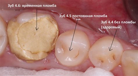 Реакция организма на процедуру установки временной пломбы