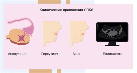 Реальность беременности при синдроме поликистозных яичников: научные разработки
