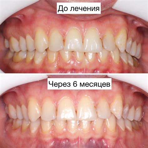 Результаты после применения элайнеров на одной челюсти