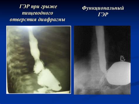 Риски и осложнения при проведении исследования "Гастроскопия" при грыже пищеводной диафрагмы