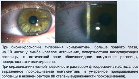 Риск возникновения инфекционных осложнений и повреждений глазной роговицы