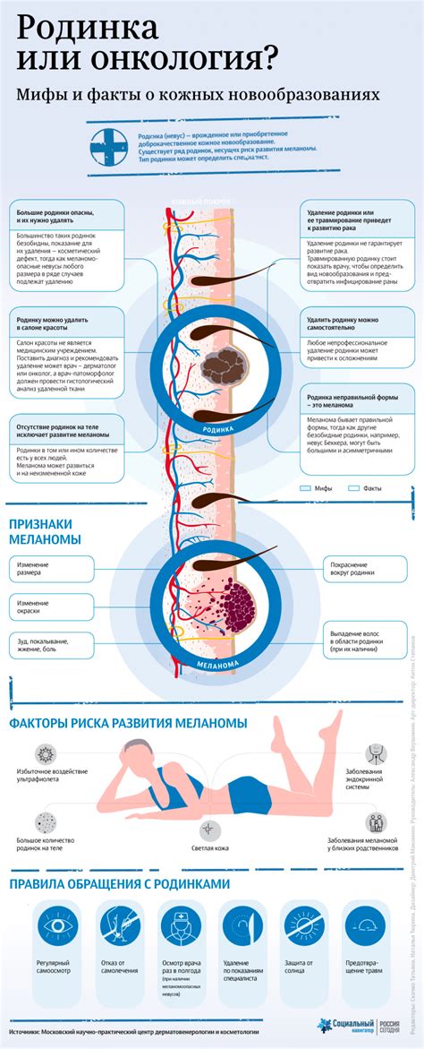 Родинки и их особенности