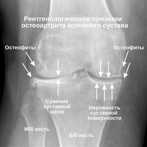 Роли физических упражнений в профилактике и лечении плоскостопия